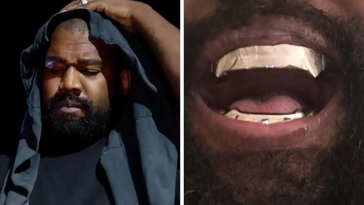 Kanye West teeth removed replaced $1.3m titanium dentures
