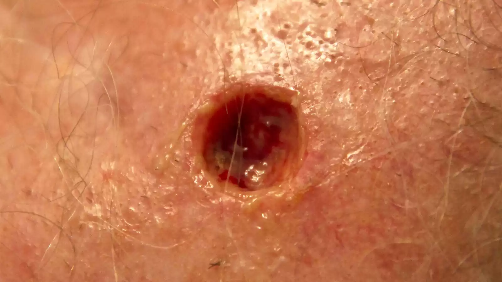 Mohs Surgery Early-Stage Merkel Cell Carcinoma: Is it the Best Approach?